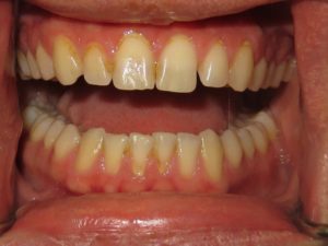 Dental Hygiene and Periodontal Health