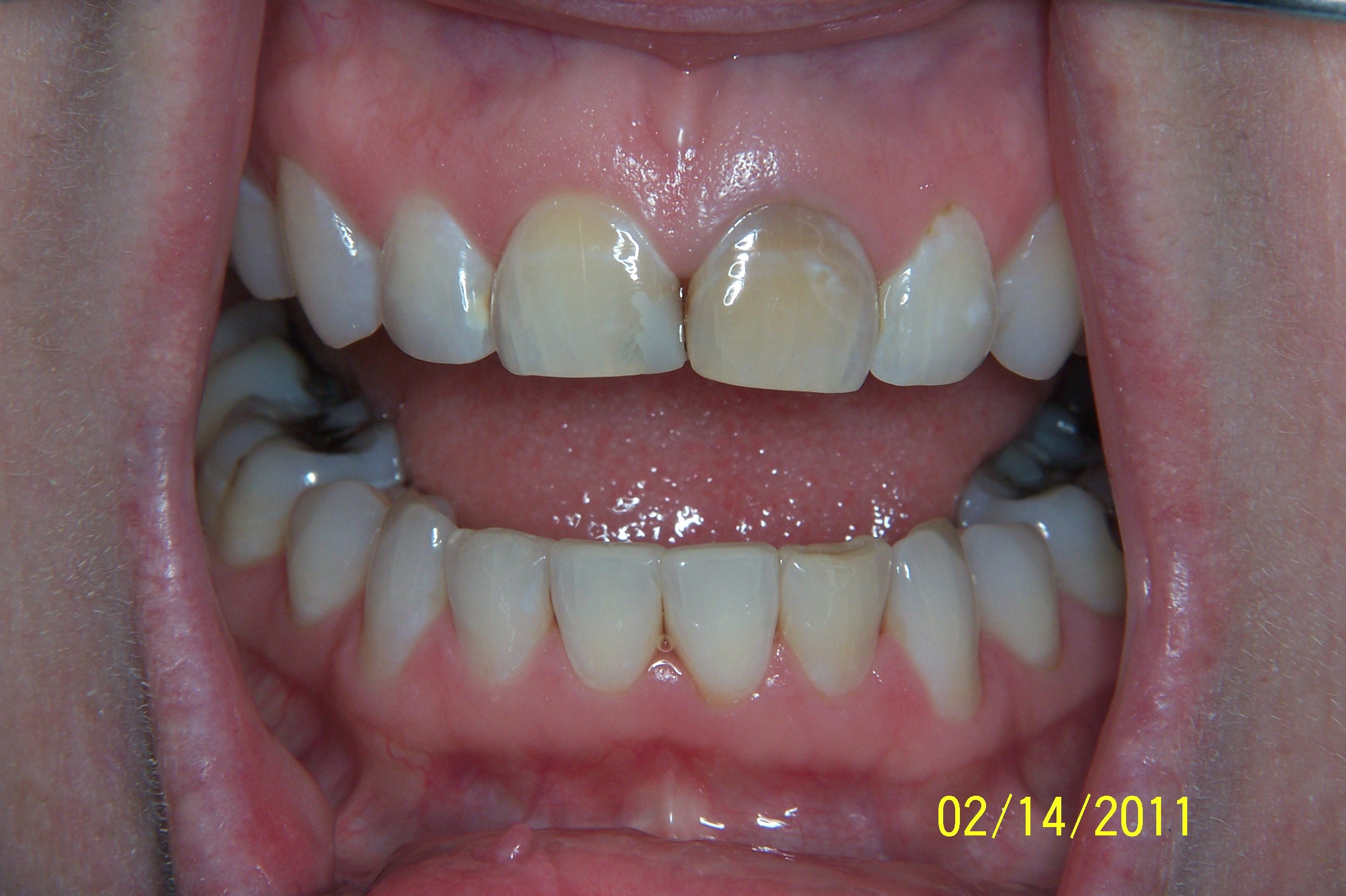 Dental Crowns Result Meridian