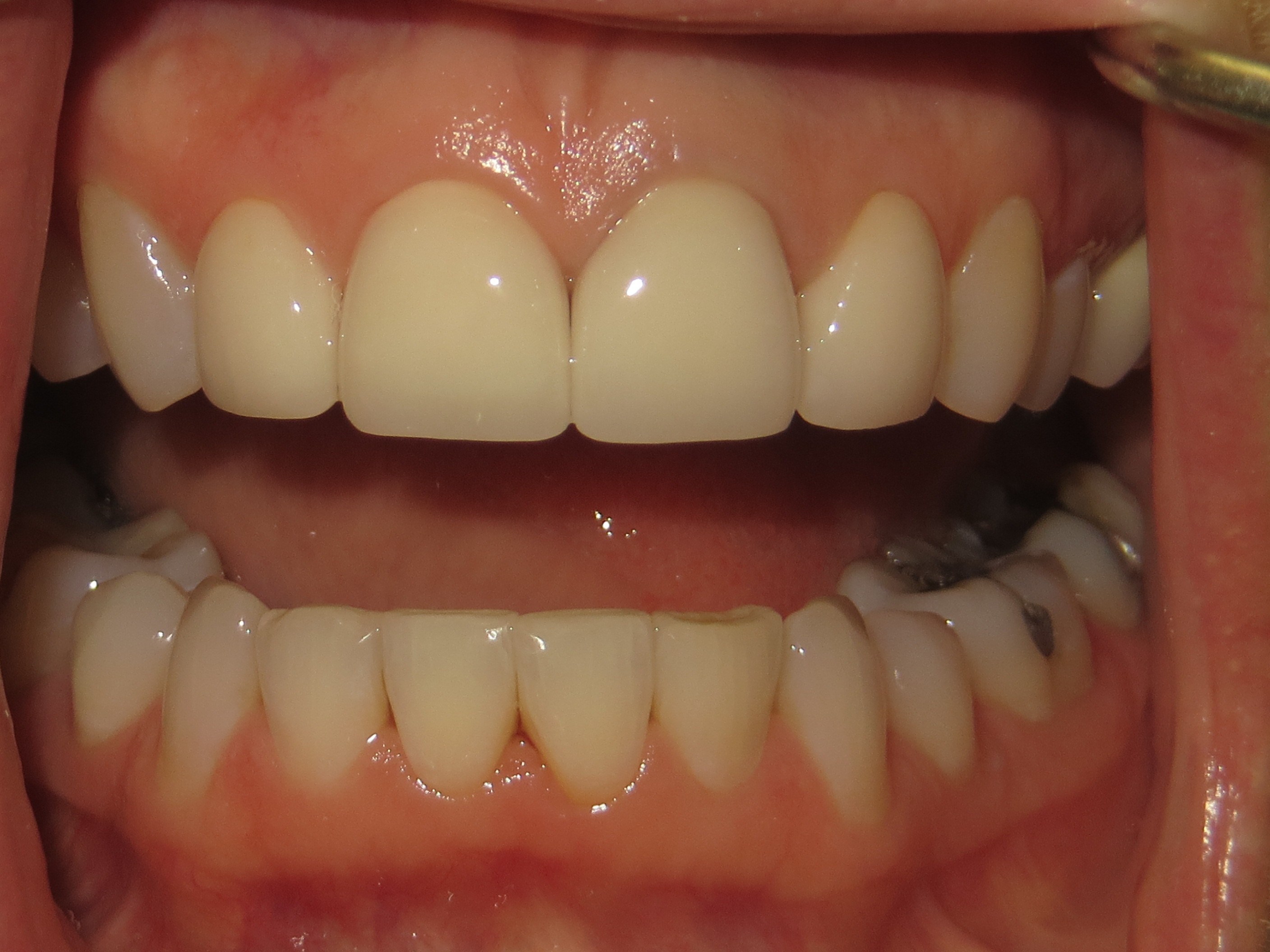 Dental Crowns Result Meridian